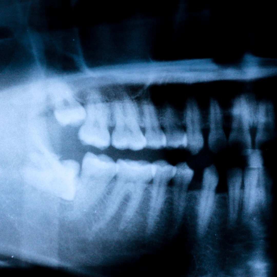 Panoramic dental X-ray of lower jaw