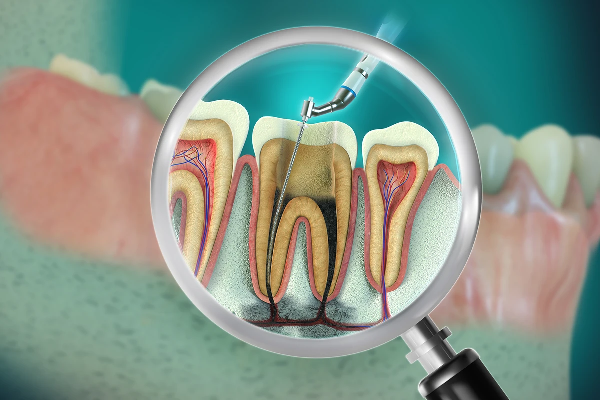 Magnified root canal treatment illustration